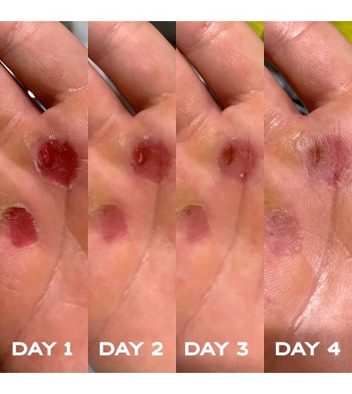 Mani strappate nel CrossFit: come prevenire le vesciche e curare i tagli rapidamente